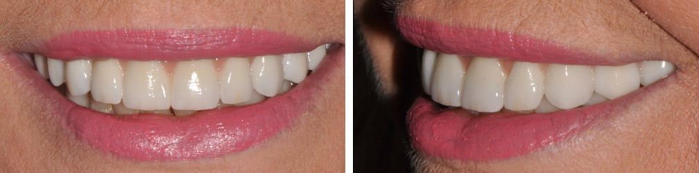 Full Mouth Reconstruction Case Study
